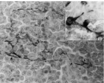 Fig. 3. Diffuse lymphoblastic thymic lymphoma—probable remnants of thymic Hassall’s epithelial bodies within the lymphoma: cells and  re-ticular structures positive for AE-1/AE3 cytokeratins