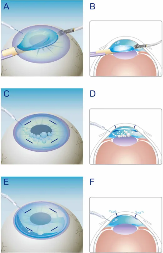 Figure 1. Schematic illustration of the modified DSAEK procedure. A, B) Donor tissue insertion