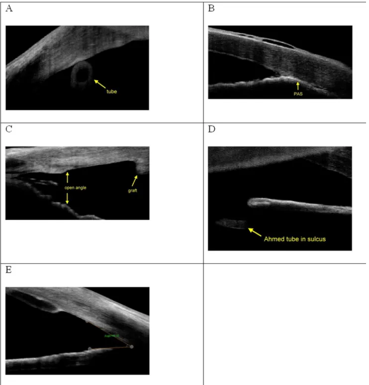 Figure 4. Postoperative follow-up AS-OCT images. A) Ahmed tube position close to the endothelium causing endothelial failure