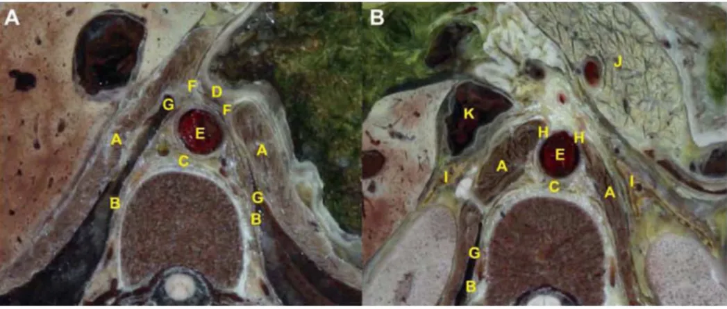Figure 1. Visualization of the anatomic location of retrocrural space across diaphragmatic hiatuses section on CVH2