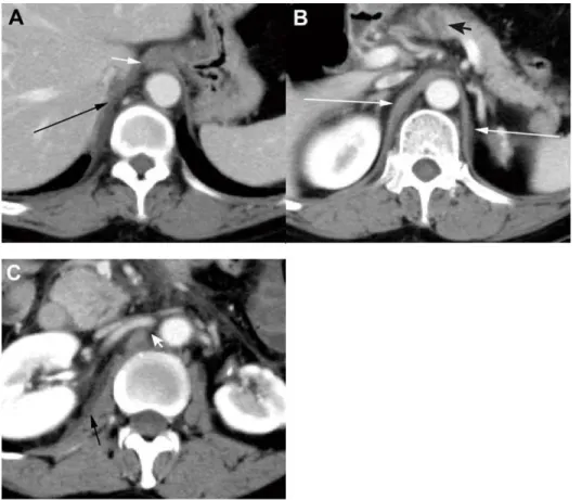 Fig. 5). A CTSI score of 4.0 was identified as the best cutoff value (maximum YI = 0.744)
