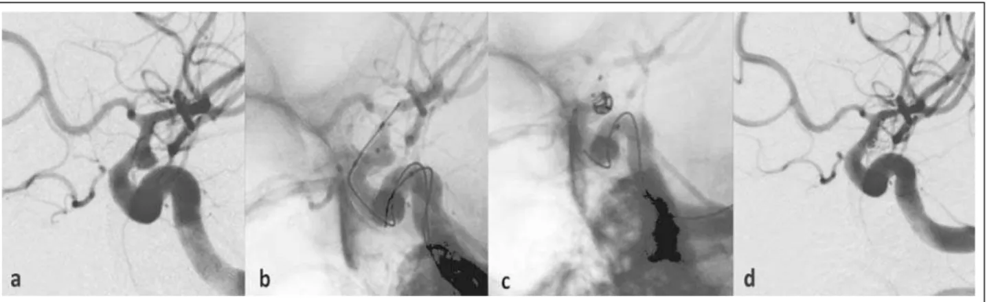 Abbildung 7: Ballongestützte Coil-Embolisation. (a) Angiographien der Arteria carotis interna im seitlichen Strahlengang zeigen ein breitbasiges Aneurysma der Karotishinter- Karotishinter-wand unmittelbar distal des Duradurchtritts