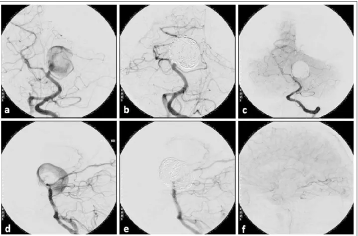 Abbildung 10: Flow-Modifi kationstechniken. Vertebralisangiogramme in (a) a.p. und (d) seitlichem Strahlengang zeigen ein größeres rupturiertes Aneurysma der linken Arteria  cerebri posterior am Übergang vom P1- zum P2-Segment