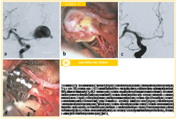 Abbildung 1: Mikrochirurgische Clippung. (a) Die Angiographie der rechten Arteria carotis interna zeigt ein  20 mm großes Aneurysma am Communicans-anterior-Komplex, das kleine Tochteraneurysma stellt die  eigentli-che Blutungsquelle dar