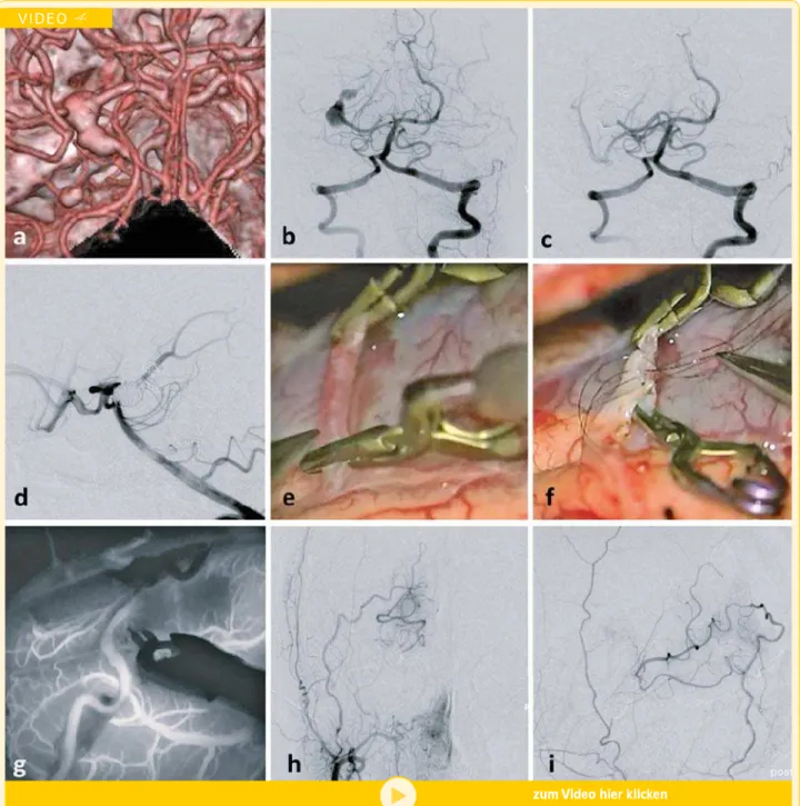 Abbildung 5: Therapeutischer endovaskulärer Gefäßverschluss unter Bypassschutz. (a) CT-Angiogramm und (b) Angiographie des Vertebralisstromgebietes zeigen ein rup- rup-turiertes, fusiformes peripheres Aneurysma der Arteria cerebri posterior rechts