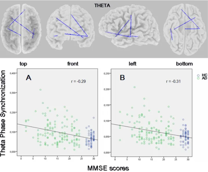 Figure 6. eLORETA wire diagram of significant correlations between theta lagged phase synchronization values and the Mini- Mini-Mental State Examination scores in patients with Alzheimer’s disease and controls (threshold: r = 20.27; p,0.05, corrected)