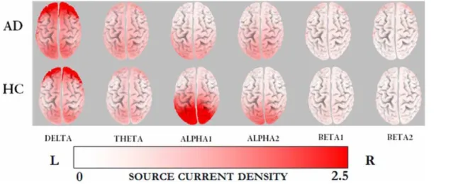 Figure 2. eLORETA statistical maps of alpha1 oscillations in patients with Alzheimer’s disease vs