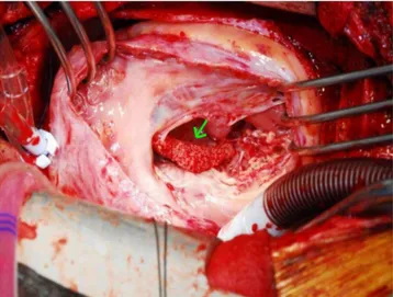 Fig.  6. A  fragile  and  easily-crumbled  mass  (arrow)  attached  to  a  dysplastic tricuspid valve