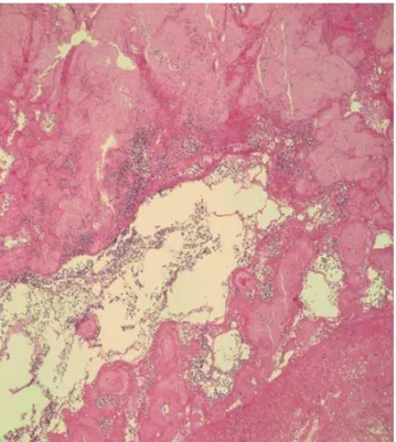 Fig.  7.  Atypical  hyperchromatic  cells  observed  on  H&amp;E  stain.  The  cardiac mass comprised an aggregation of small, round, necrotic cells  consistent with leukemic cells (×400).