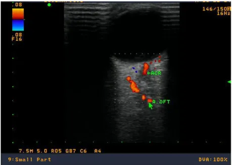 Figura 3: ilustra a imagem da Artéria Oftálmica em seu cruzamento medial ao Nervo  Óptico, identificado por ultrassom com modo Doppler colorido