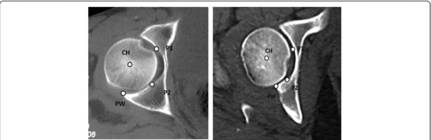Figure 1 In a non fractured acetabulum, four points were defined: P1! anterior transition between the articular surface and the acetabular fossa