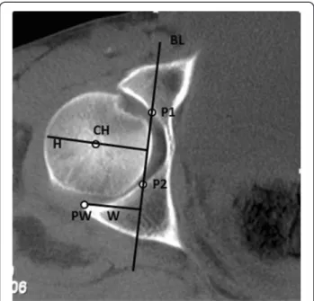 Figure 2 A straight base line (BL) was drawn throw the P1 and P2 points, and 2 other lines were drawn perpendicular to the BL line: Line W, from the PW point to BL line; and another line H, from the lateral edge of the femoral head, passing through CH poin