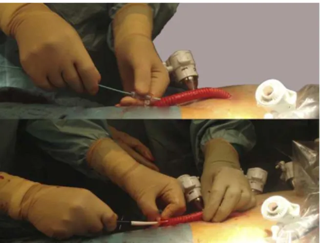 Fig 6. Different sites of end-site anastomosis with the Dacron graft.