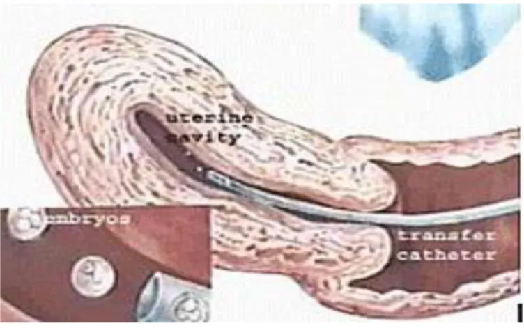 Figura 6 - Transferência de embriões para o útero, guiada por ultrassonografia abdominal 