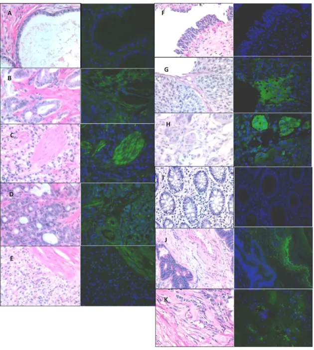 Figure 3. Tissue staining of OATP1B3 expression in cancer. Concurrent tissue sections stained with hematoxylin and eosin (left panel) and immunofluoresence (right panel) for OATP1B3