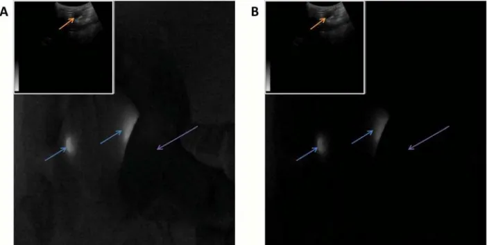 Fig 4. Goggle aided stereoscopic imaging with ultrasound. 2 fluorescent targets (blue arrows) implanted into the chicken breast at depths of approximately 3 mm