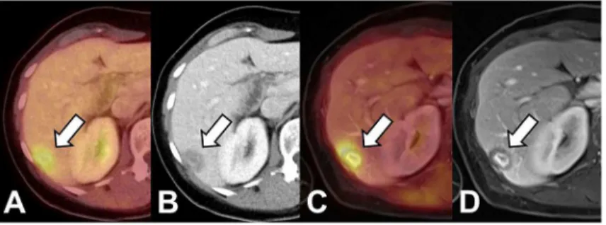Fig 2. Patient with breast cancer. Both PET/CT (A,B) as well as PET/MRI (C; D; VIBE, portal venous phase) show a lesion with elevated FDG-uptake and ill-defined lesion borders as well as central contrast enhancement as signs of malignancy