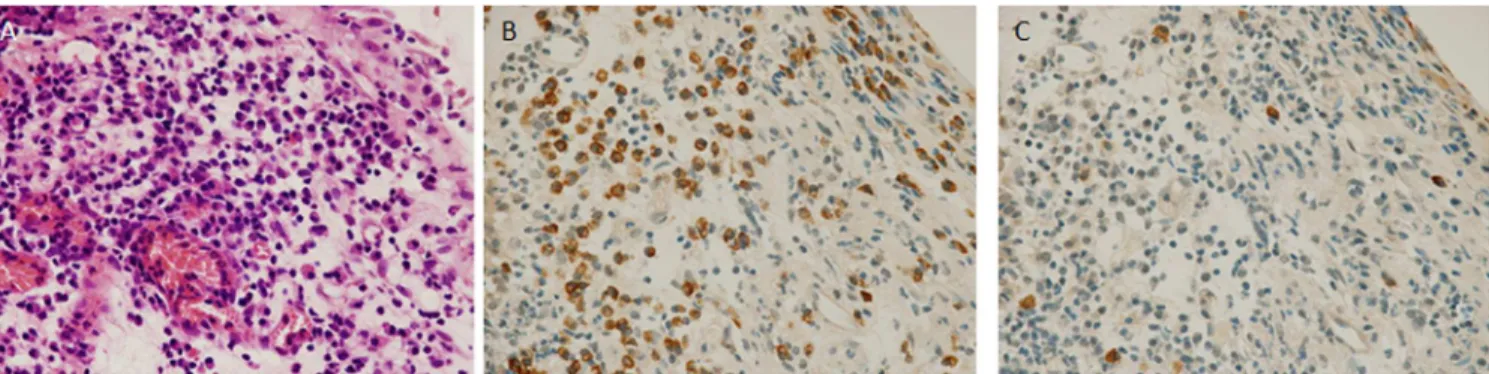 Fig 6. Hunner-type/classic IC (HIC) specimen with expansion of light chain-restricted B cells (κ >>> λ)