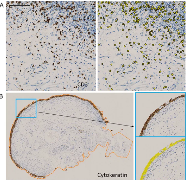 Fig 1. Digital image analysis. (A) Quantification of CD3-positive cells. CD3 immunostaining (left) and identification of CD3-positive cells by image analysis software (right)