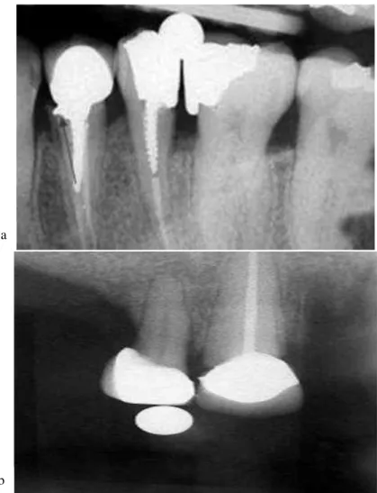 Figure 3.a. Radiographic projection illustrating horizontal marginal discrepancy in the form of ledge formation