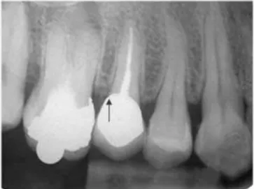 Figure 4. Radiographic picture showing invasion of the restoration margin to the biologic width (arrow) 