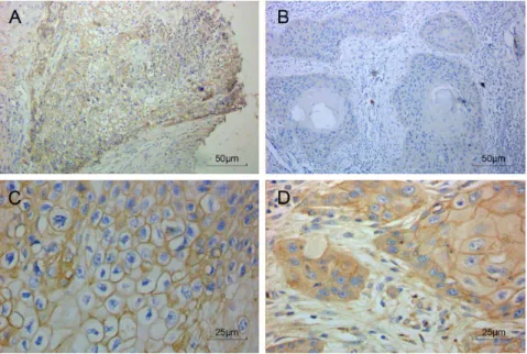 Figure 1. MCT4 expression in oral squamous cell carcinoma by immunohistochemistry. Representative images of tumor and associated stroma (A, C–D) as well as adjacent normal tissue (B) were stained for MCT4 (brown)