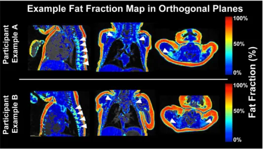 Figure 4. Neonatal Segmentations. BAT (brown adipose tissue) segmentations in the neonate