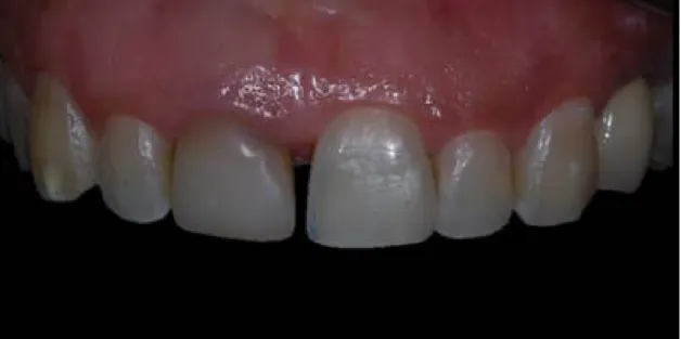 Figura 1: Aspecto inicial do dente 11 com alteração de cor e com estética  gengival comprometida