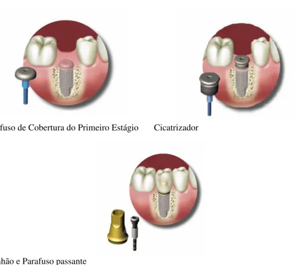 Figura 2.2: Componentes protéticos. (http://www.biohorizons.com)  
