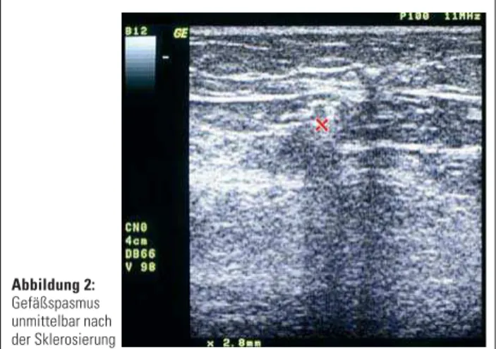 Abbildung 1: V. saphena magna und Seitenast vor Sklerosierung Abbildung 2: Gefäßspasmus unmittelbar nach der Sklerosierung