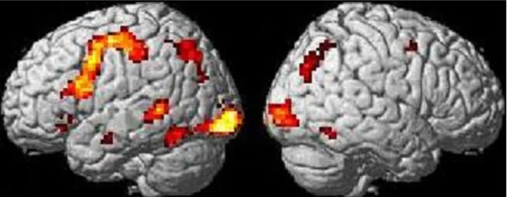 Figure 2. Different brain activations for processing among cases: ANOVA. The left and right figures show the left and right hemispheric activation results, respectively
