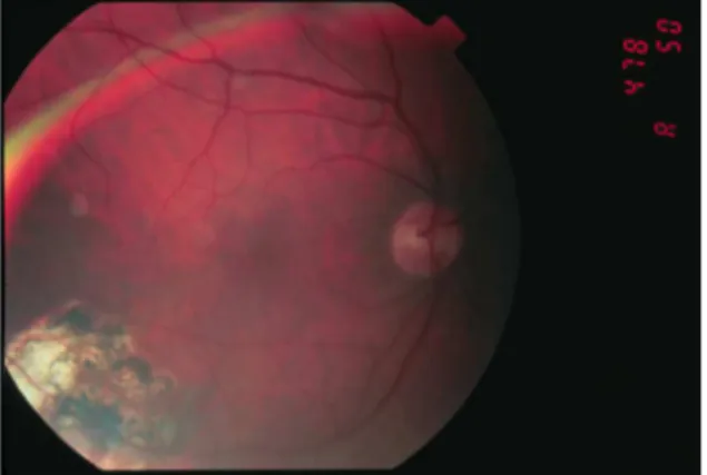 Figure  1  -  Chorioretinal  lesion  associated  with  retinal  vasculitis and microangiopathy