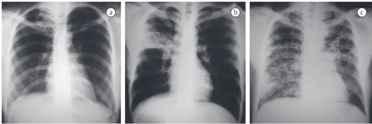 Figura 1 - Radiografias de tórax de pacientes com tuberculose pulmonar. Em a), homem de 24 anos de idade  com perda ponderal nos últimos três meses e febre atual (38°C)