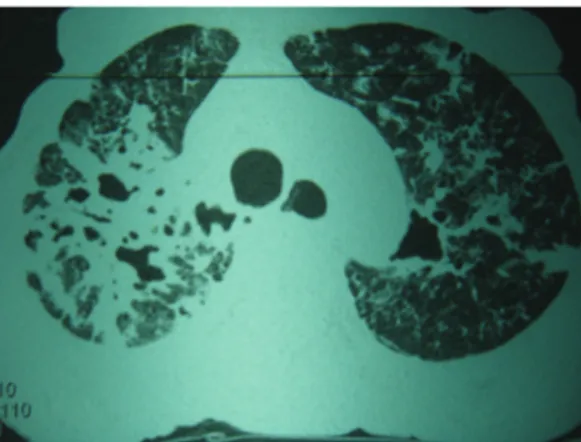Figura 1 - TCAR de tórax: fibrosis y condensación  pulmonar bilateral, subpleural, y cavidades múltiples.