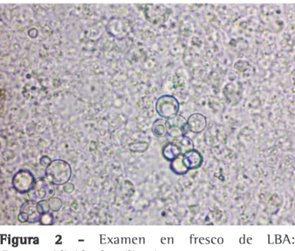 Figura 3 - Microscopía de cultivo del LBA: filamentos,  macro y microconidios de  Histoplasma capsulatum .