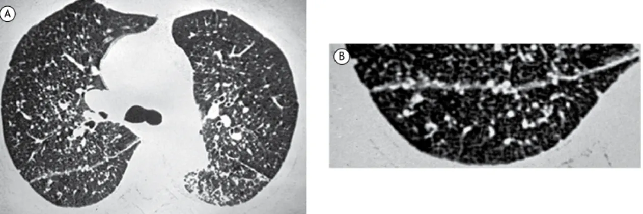 Figura 1. TCAR com corte obtido com janela para pulmão no nível da bifurcação brônquica evidencia pequenos nódulos  intersticiais distribuídos pelos pulmões