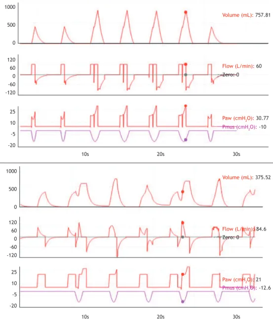 Figure 3. Volume, ﬂ ow, and pressure waveforms, respectively, illustrating two simulations of asynchrony