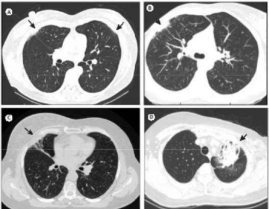 Figure 1. HRCT scans showing features of radiation pneumonitis. In A, HRCT scan scored as 1 in a patient submitted  to bilateral treatment