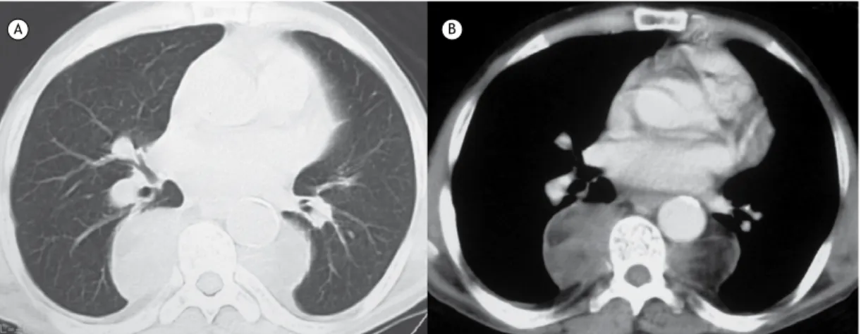 Figura 1. TCs de tórax com janela para pulmão (em A) e para mediastino (em B) mostrando massas bilaterais na região torácica  paravertebral inferior