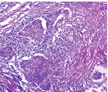Fig. 1: Tumour Cells Growing in Nests Inter- Inter-mingled with Lymphoid Stroma(H &amp;E,10X) Neoplastic  cells  exhibited  syncytial  appearance  with  indistinct  cell  border,  eosinophilic   cyto-plasm,  large  vesicular  nuclei  and  prominent  nucleo
