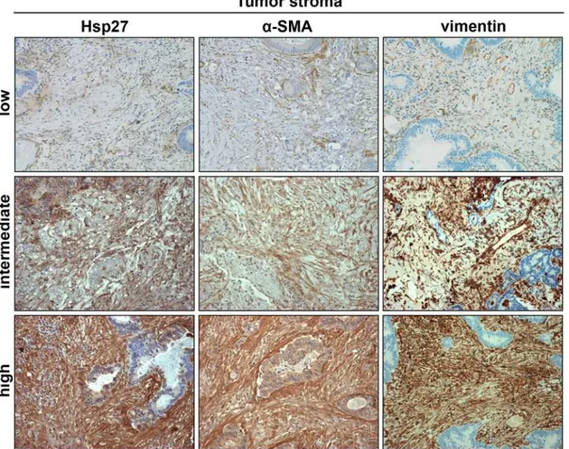 Fig 1. Representative images showing pulmonary metastases with low, intermediate and high intensity of positive tumor stroma stained for Hsp27 and α-SMA