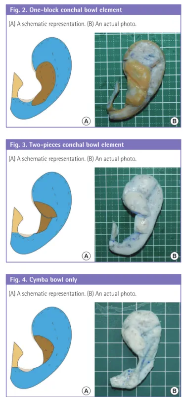 Fig. 3. Two-pieces conchal bowl element (A) A schematic representation. (B) An actual photo