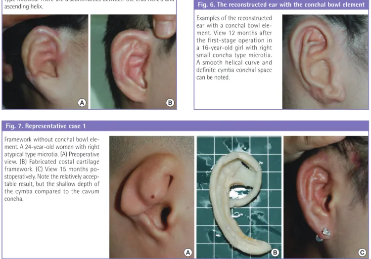 Fig. 5. The reconstructed ear without the conchal bowl ele- ele-ment