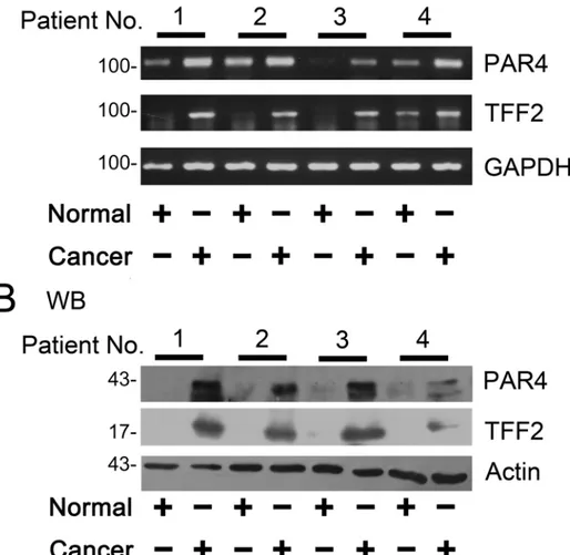 Fig 1. Expression of PAR4 and TFF2 in colorectal cancer tissues. (A) The matched normal (normal) and cancerous (cancer) tissues from each patients selected randomly were analyzed by RT-PCR using  PAR4-and GAPDH- specific primers (n = 4)