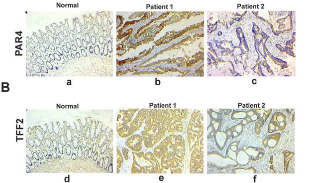 Fig 3. Representative photomicrographs of immunohistochemical staining of PAR4 and TFF2 in paraffin sections of colorectal tissues