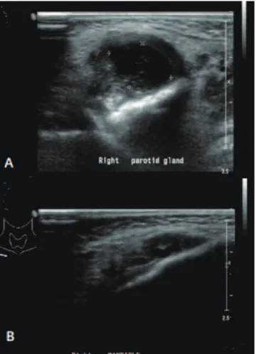 Fig. 1.  Ultrasonography of face and neck. (A) At the 5th hospital day,  early abscess formation was seen in the right masticator space