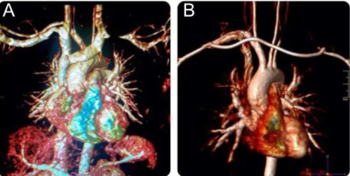 Figure 2. Preoperative  and postoperative(axillo-axillary bypass)   MR angiography image of a 39-year-old female.