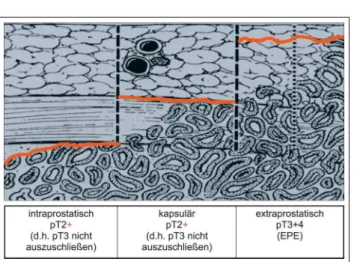 Abbildung 2: Häufigkeit der extraprostatischen Expansion (EPE) und ihre bevorzugte Lokalisation an der Prostata dorsal und lateral.