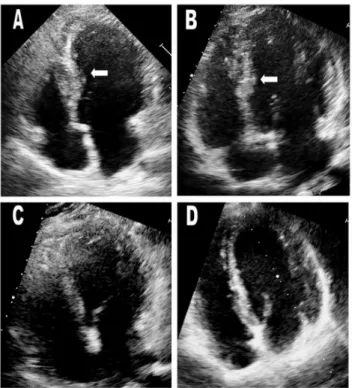 Figure 3. Echocardiograms of the proband (III-2) and his younger brother (III-3) (A&amp;B)