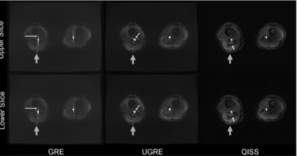 Figure 4. Artifacts in GRE, UGRE and QISS. The upper row visualizes the flow artifact in GRE images, aliasing in UGRE, and B 1 inhomogeneity in QISS, in each case marked by a white arrow